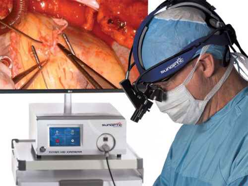 Sunoptic-surgical_HDC–300-HD-Headlight-Surgical-Camera-operation